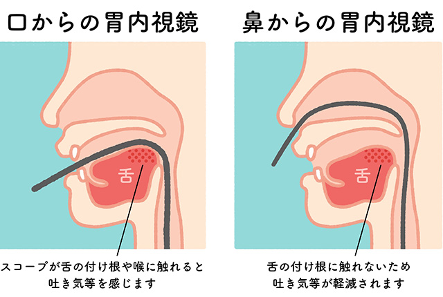 苦痛を軽減する胃内視鏡検査の特徴